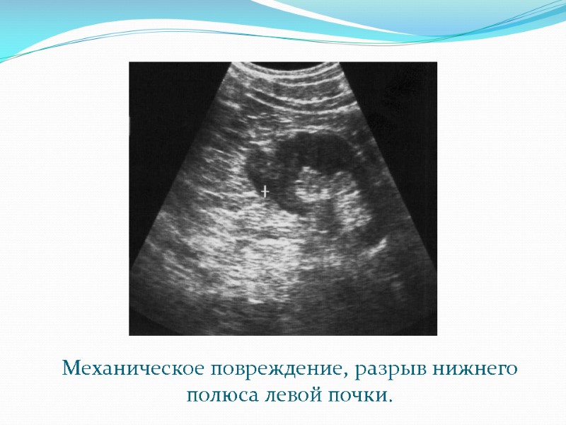 Механическое повреждение, разрыв нижнего полюса левой почки.